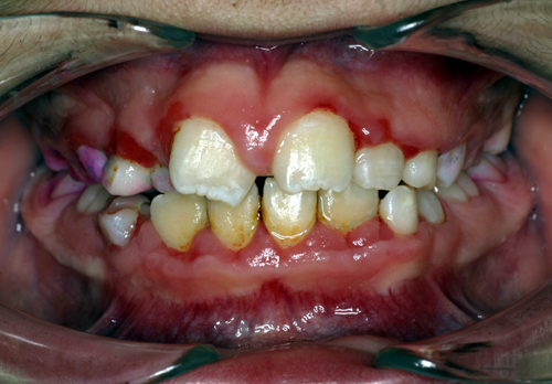 The mixed dentition contains both primary and permanent teeth.