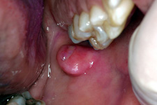 A fibroma is a commonly found lesion on the oral tissues.