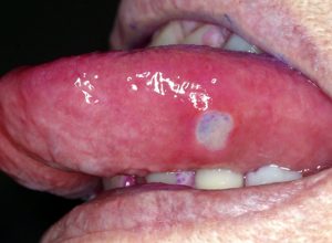 Aphthous ulcers present on movable tissue.