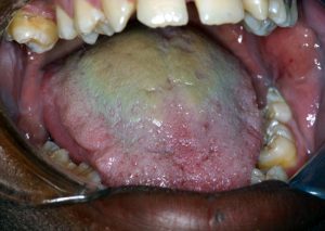 Hairy tongue represents an elongation of the filiform papillae.