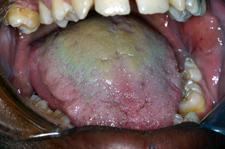 Hairy tongue represents an elongation of the filiform papillae.