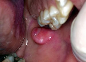 A fibroma is a commonly found lesion on the oral tissues.