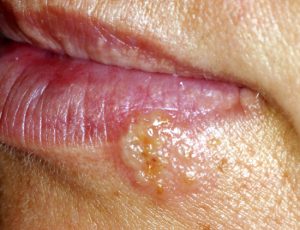 Herpes simplex lesions are mainly found on the perioral tissues.